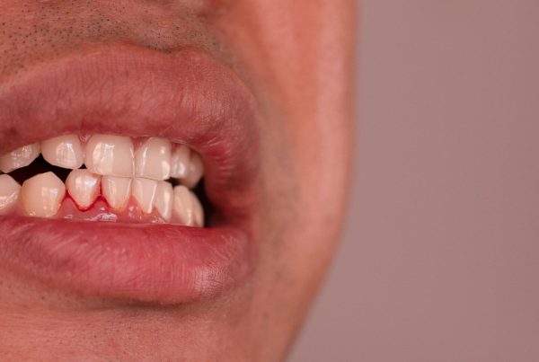 Diş Eti Kanaması Neden Olur, Nasıl Geçer?