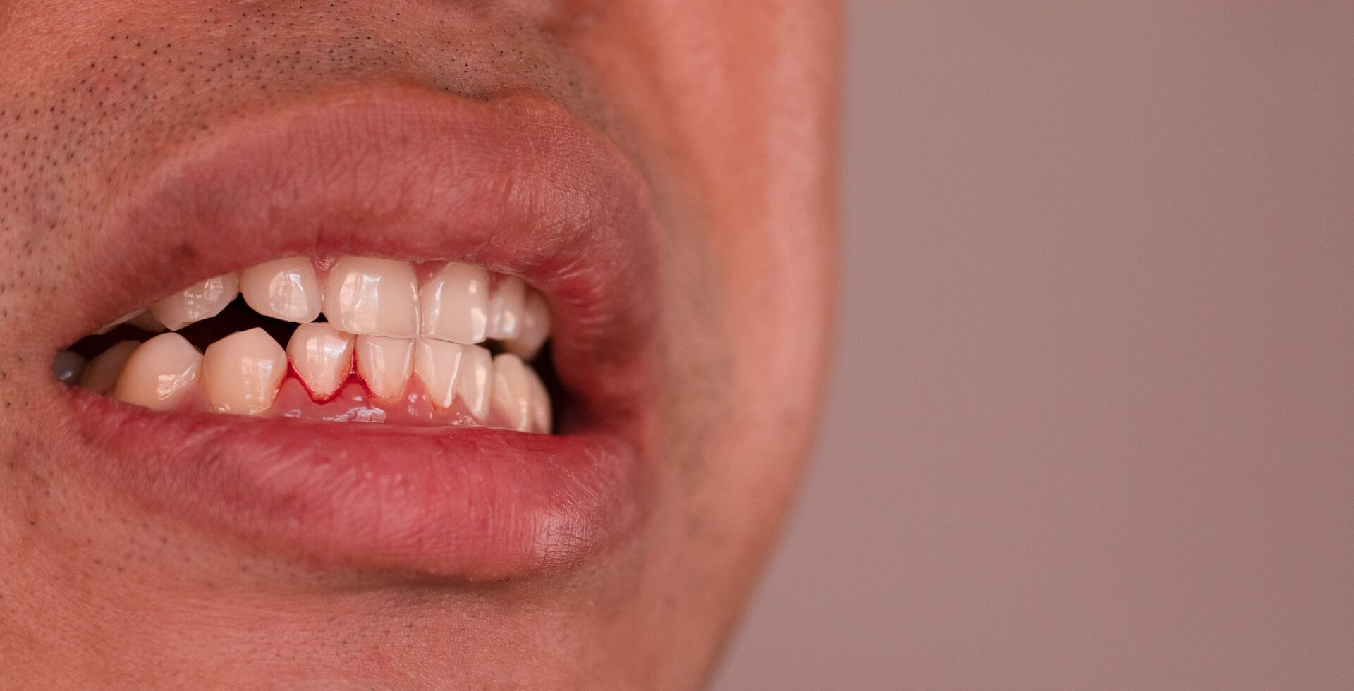 Diş Eti Kanaması Neden Olur, Nasıl Geçer?