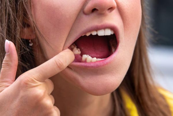 Genç Yaşta Diş Kaybı Neden Olur?