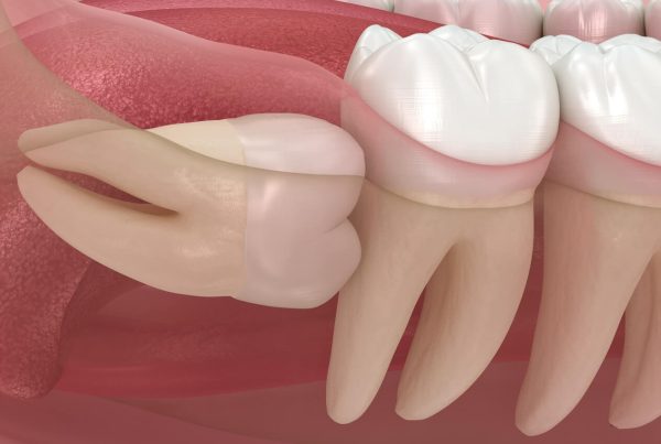 20’lik Diş Ağrısı: Neden Olur ve Çözüm Yolları