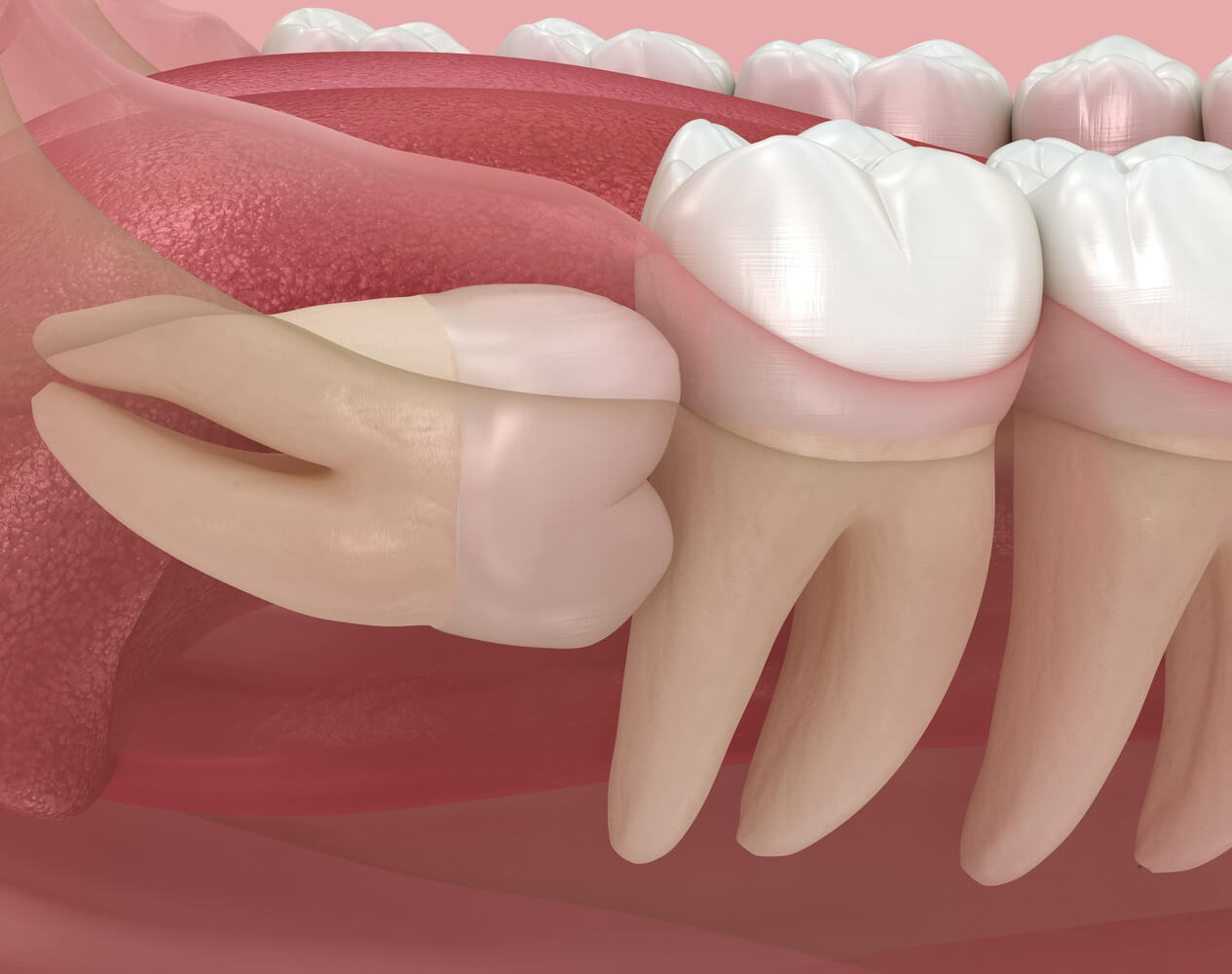 20’lik Diş Ağrısı: Neden Olur ve Çözüm Yolları