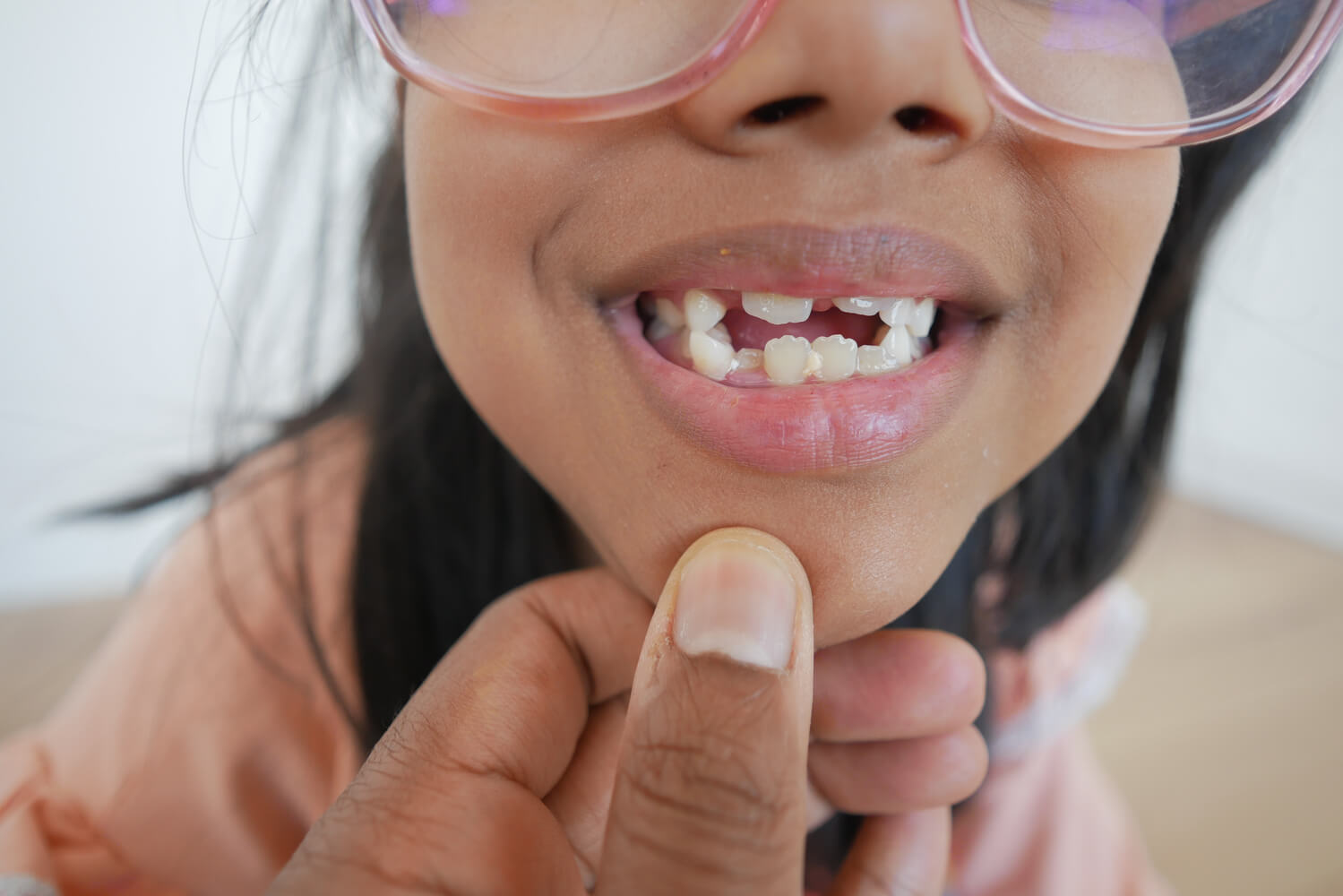 Diş Eksikliği Çene Yapısını Nasıl Etkiler?