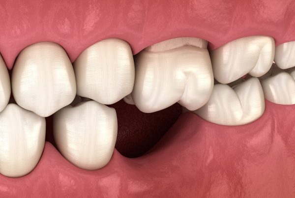 Diş Kemiği Erimesi Diş Kaybına Yol Açar mı?