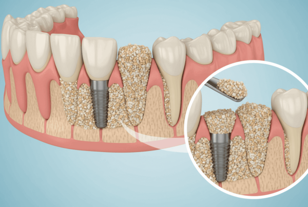 Kemik Tozu Nedir, Ne Zaman Gerekir?